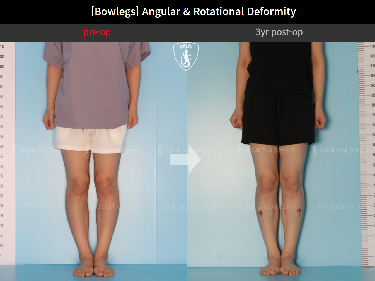 Before and after adult bowlegs, case 9678047, image 5, Dr. Donghoon institute (DALRI)
