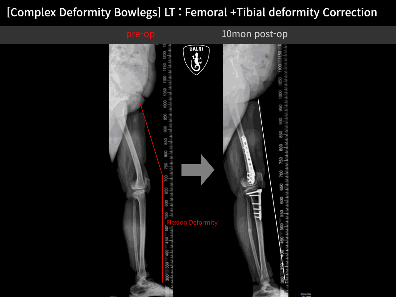 Before and after adult bowlegs, case 12790433, image 8, Dr. Donghoon institute (DALRI)