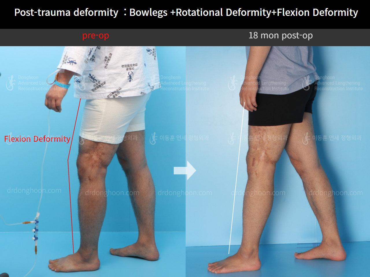 Before and after post-trauma deformity, case 4595393, image 4, Dr. Donghoon institute (DALRI)