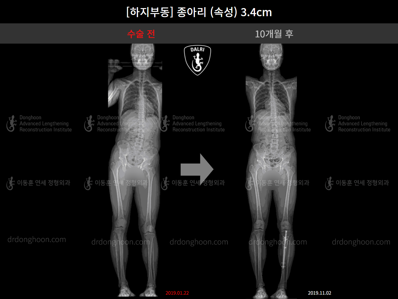 Before and after adult lld, case 4585742, image 7, Dr. Donghoon institute (DALRI)