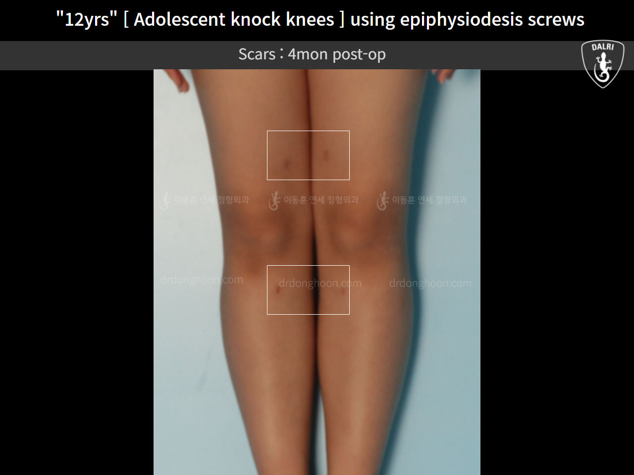 Before and after paediatric & adolescent knock knees, case 11772917, image 5, Dr. Donghoon institute (DALRI)