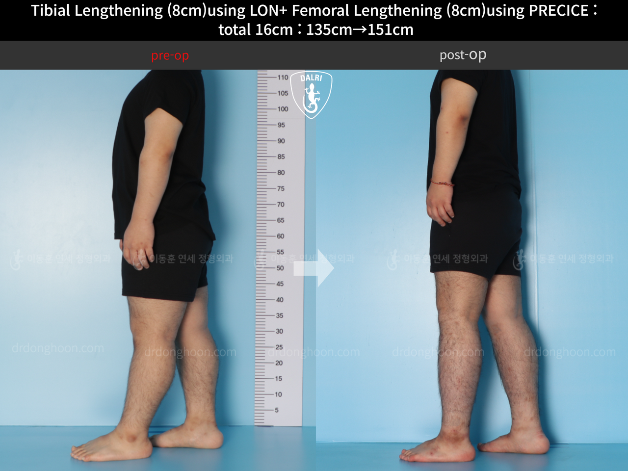 Before and after cll precice, case 12493963, image 6, Dr. Donghoon institute (DALRI)