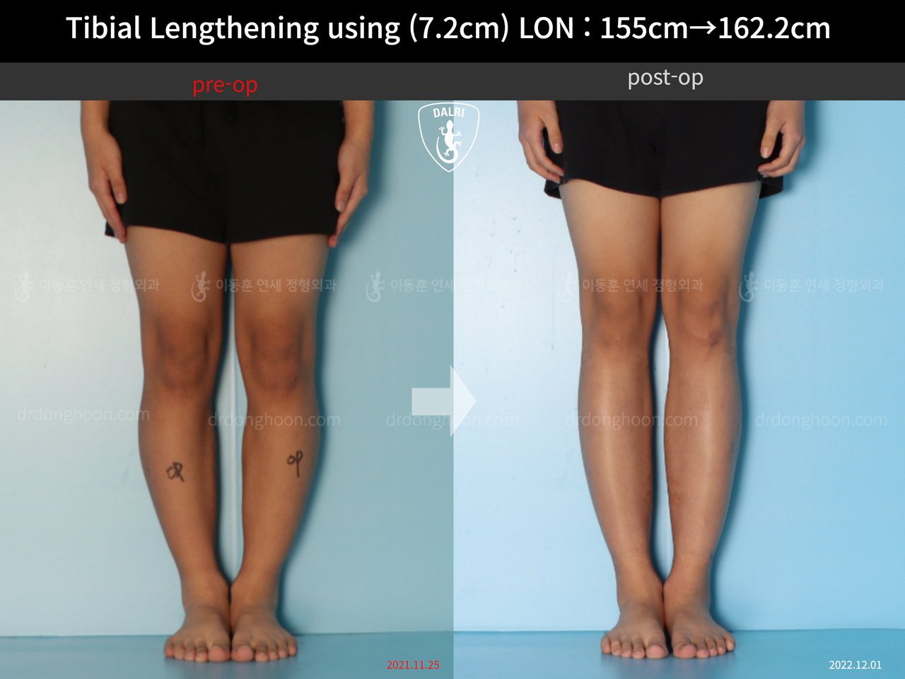 Before and after cll lon, case 13635674, image 7, Dr. Donghoon institute (DALRI)