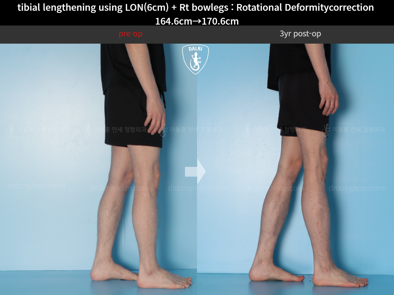 Before and after cll + deformity correction, case 15347322, image 9, Dr. Donghoon institute (DALRI)