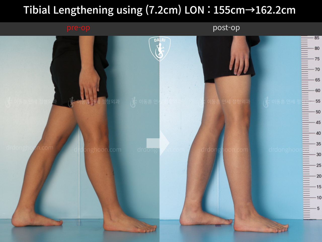 Before and after cll lon, case 13635674, image 10, Dr. Donghoon institute (DALRI)
