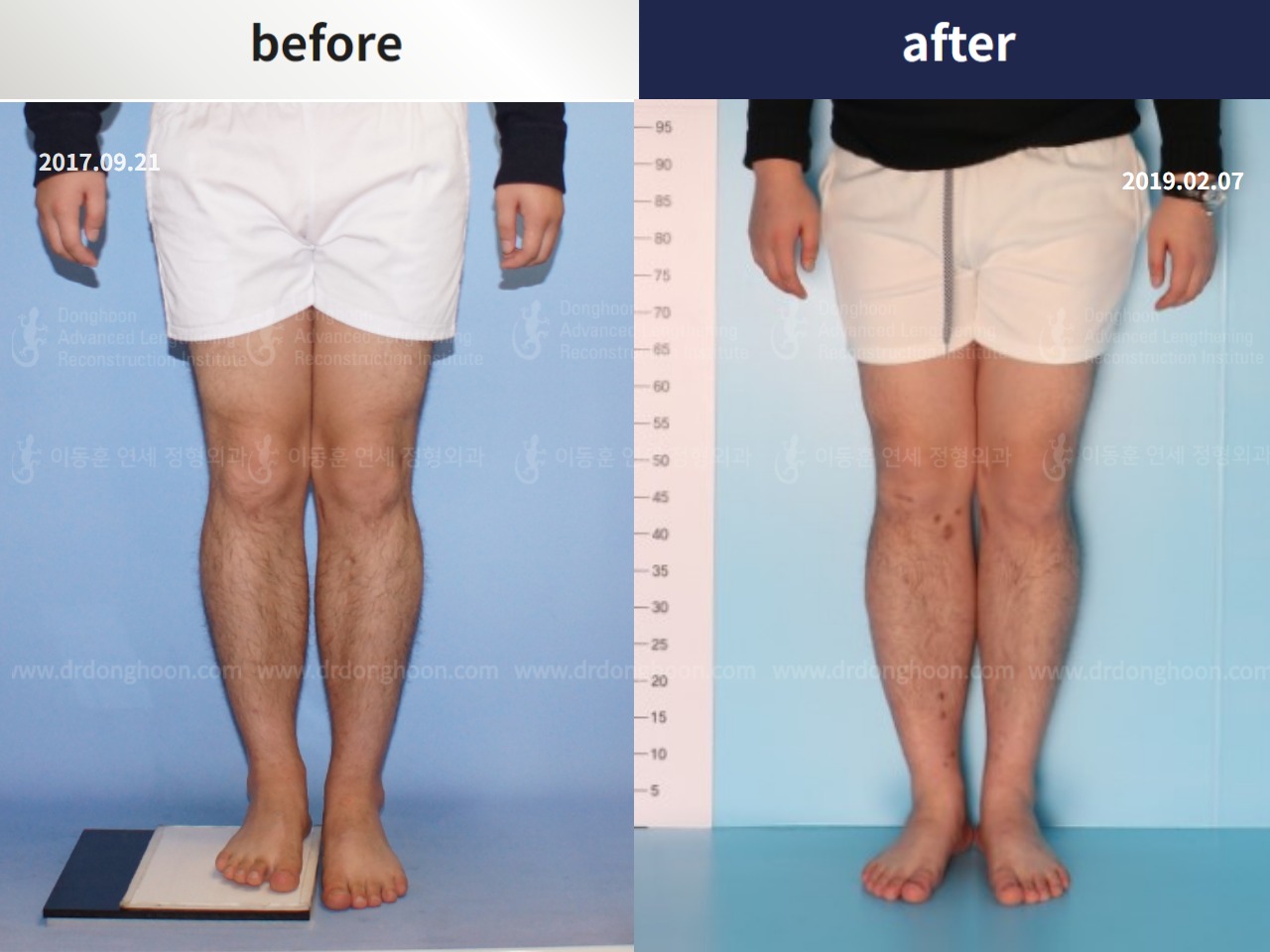 Before and after adult lld, case 4320305, image 4, Dr. Donghoon institute (DALRI)