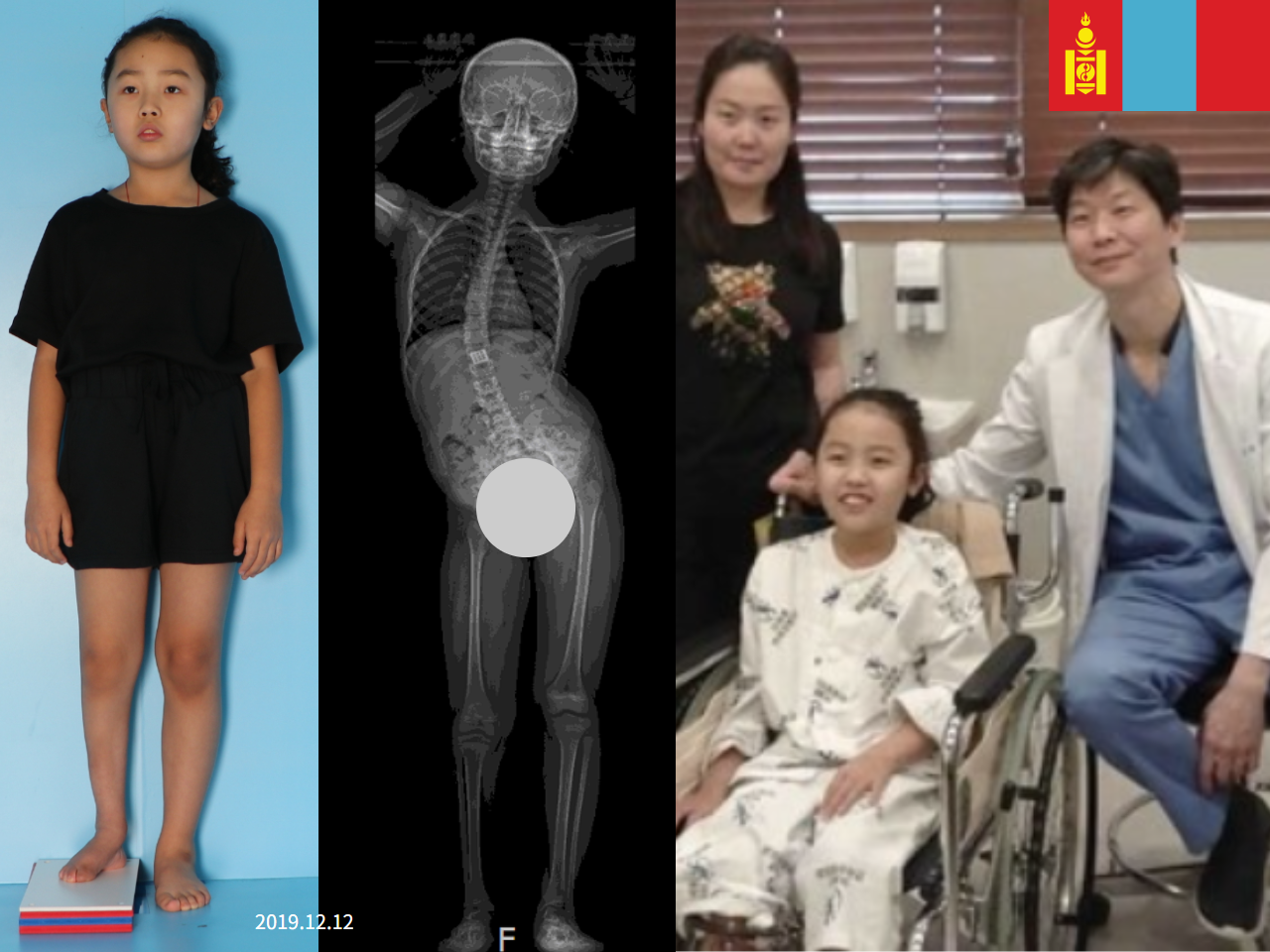 Before and after paediatric congenital condition, case 4304809, image 1, Dr. Donghoon institute (DALRI)