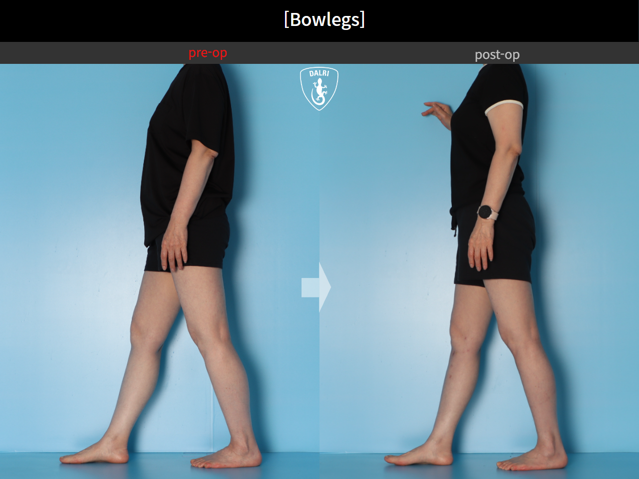 Before and after adult bowlegs, case 30256399, image 6, Dr. Donghoon institute (DALRI)