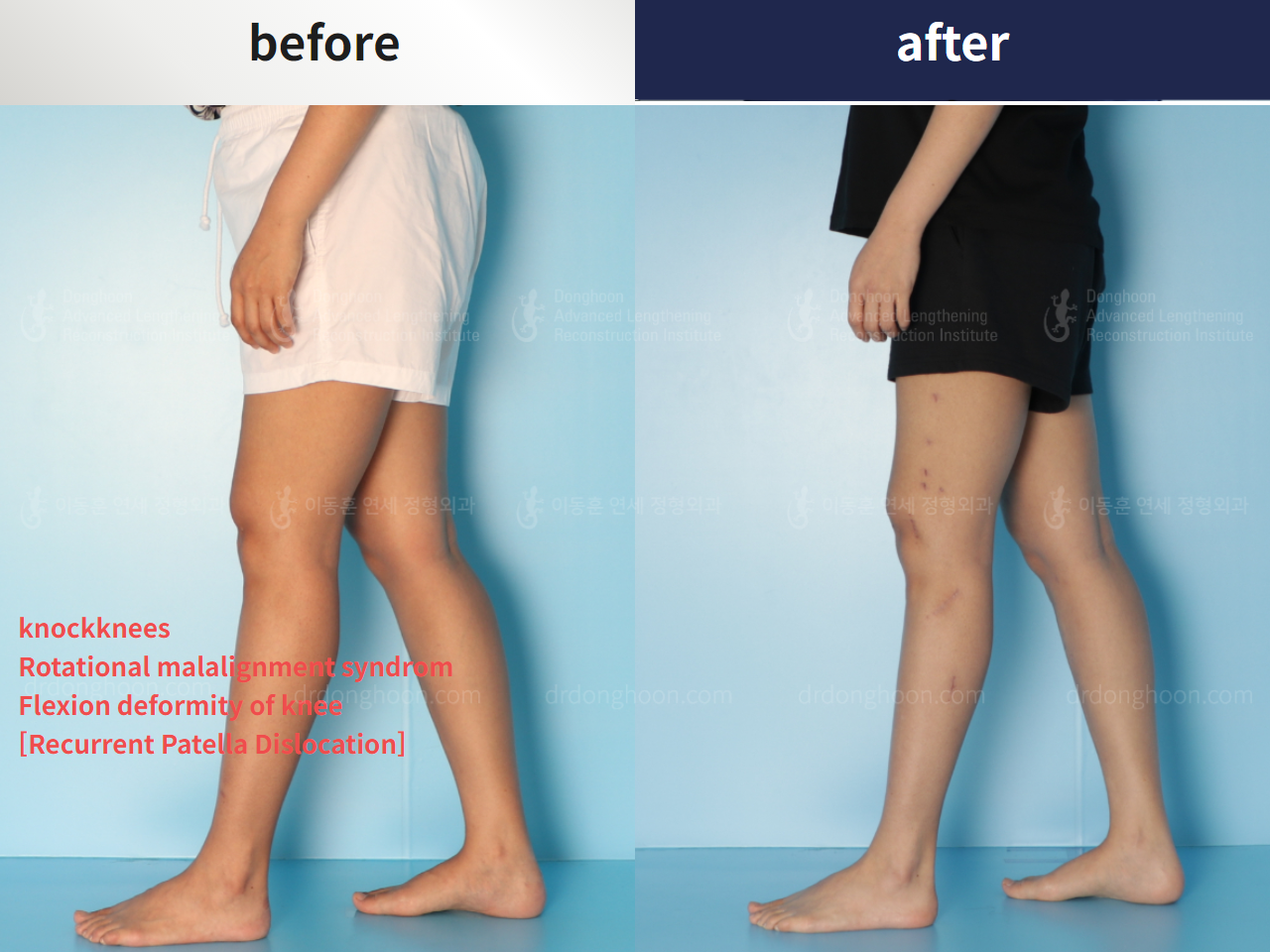 Before and after adult knock knees, case 4310881, image 1, Dr. Donghoon institute (DALRI)