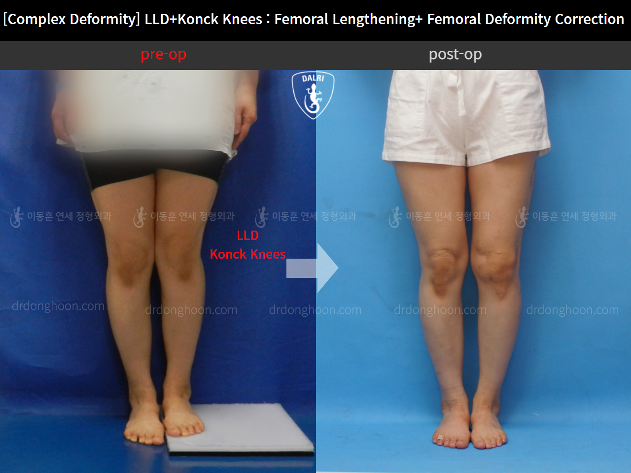 Before and after adult lld, case 11107365, image 3, Dr. Donghoon institute (DALRI)