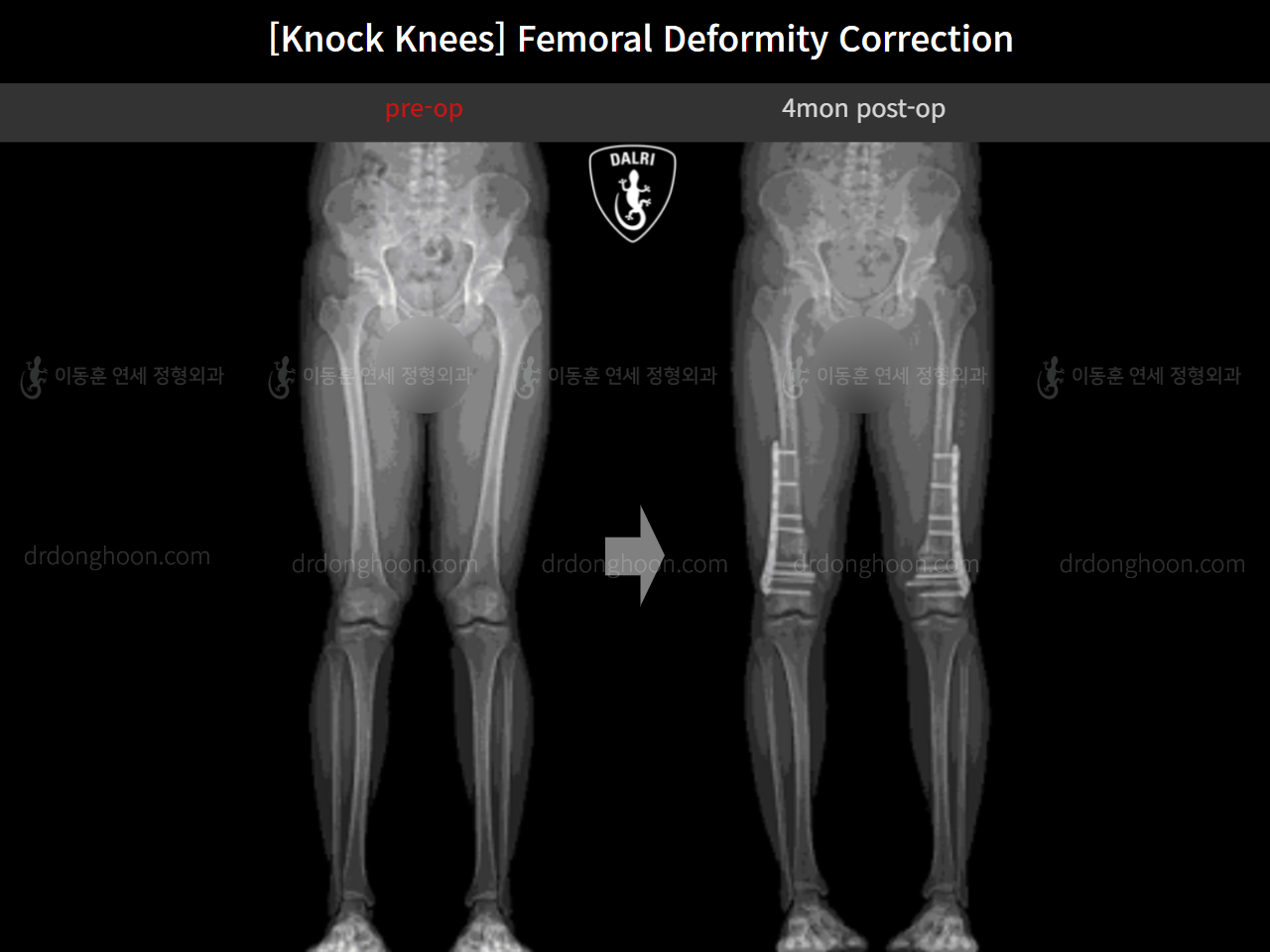 Before and after adult knock knees, case 15816319, image 11, Dr. Donghoon institute (DALRI)