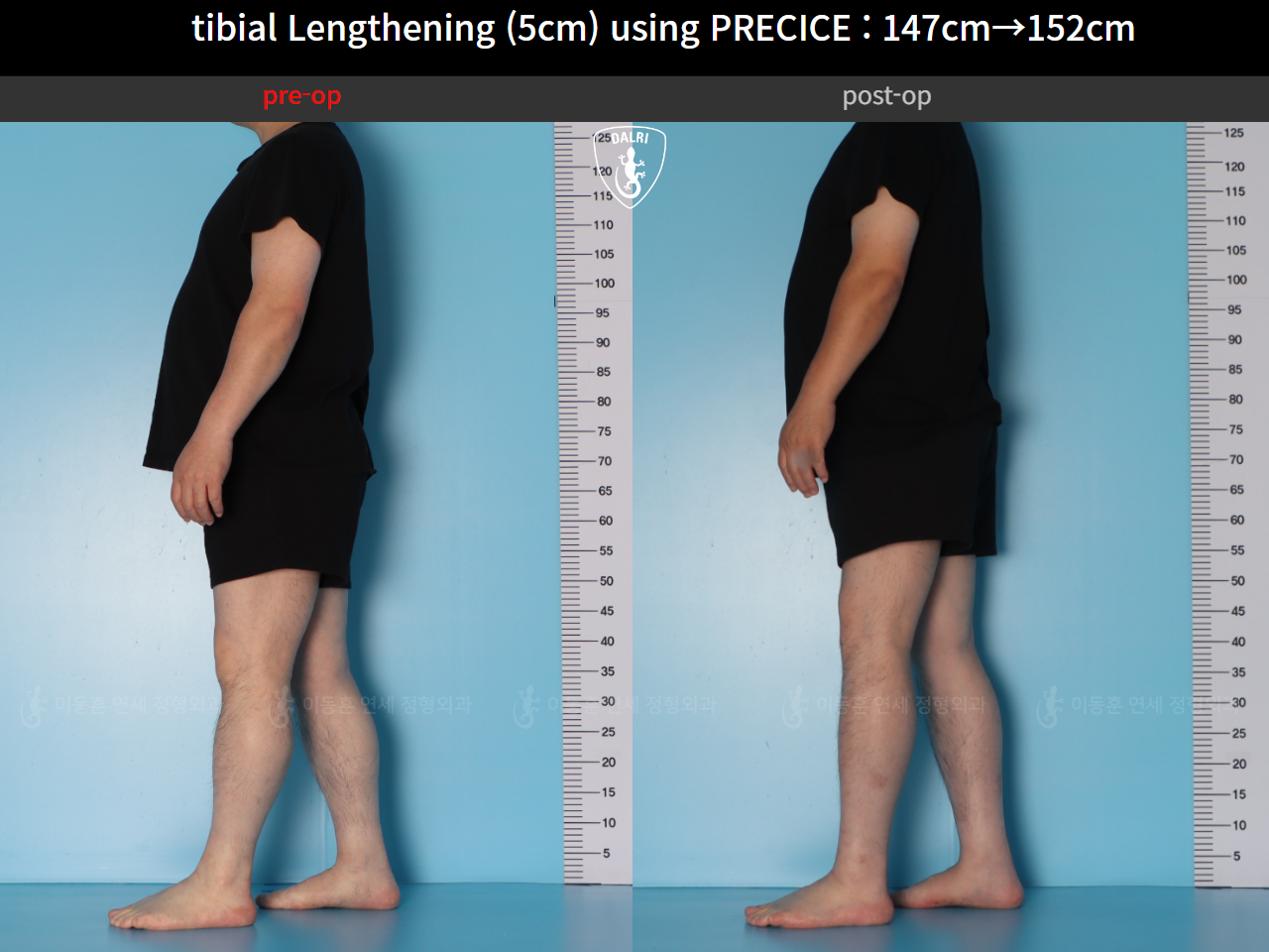 Before and after cll precice, case 89098588, image 3, Dr. Donghoon institute (DALRI)