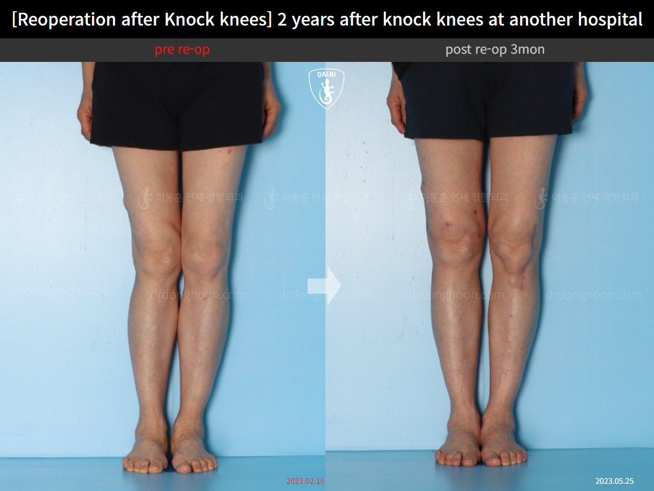 Before and after reoperation after deformity correction, case 15622876, image 6, Dr. Donghoon institute (DALRI)