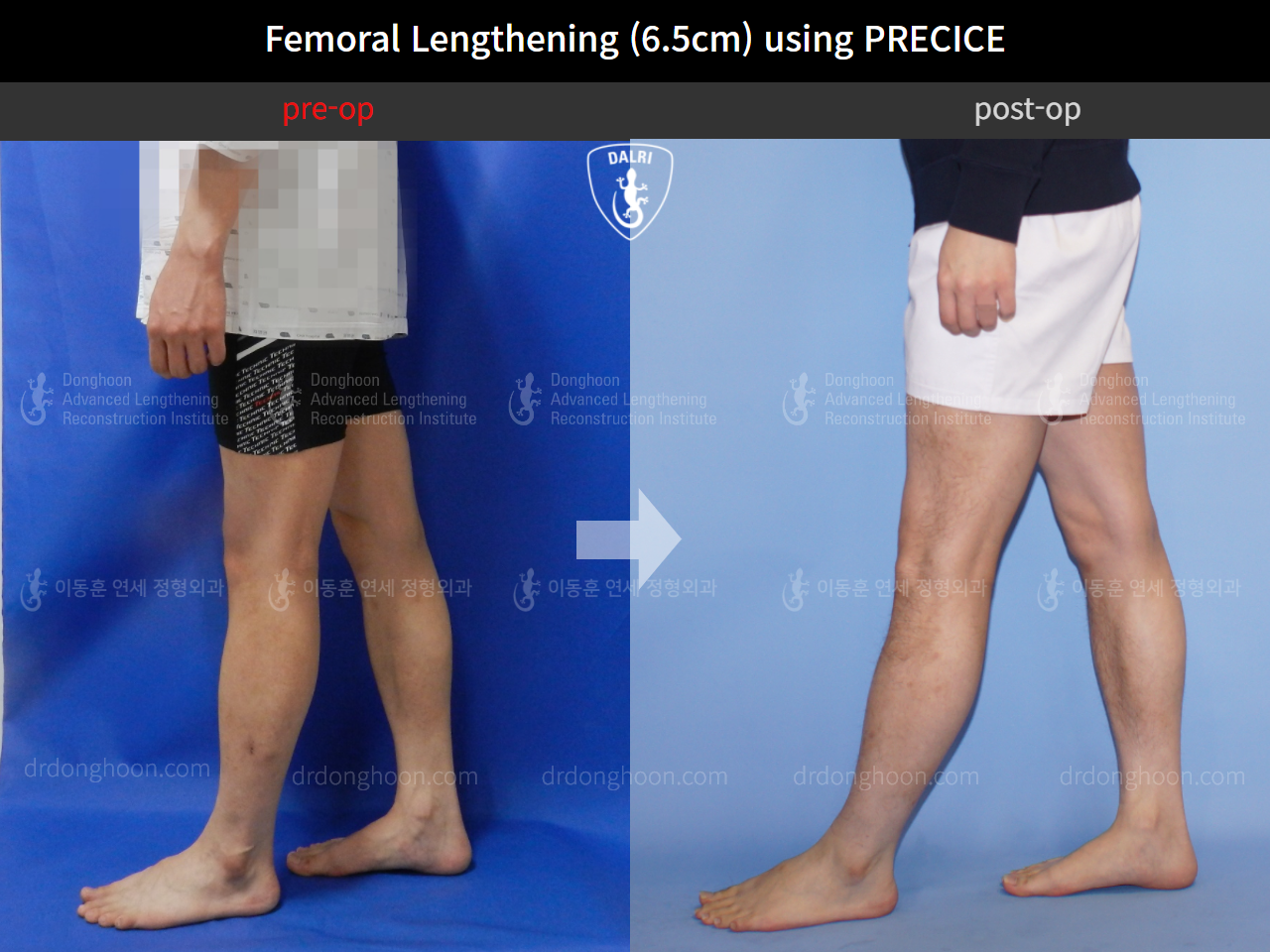 Before and after cll precice, case 4323401, image 7, Dr. Donghoon institute (DALRI)