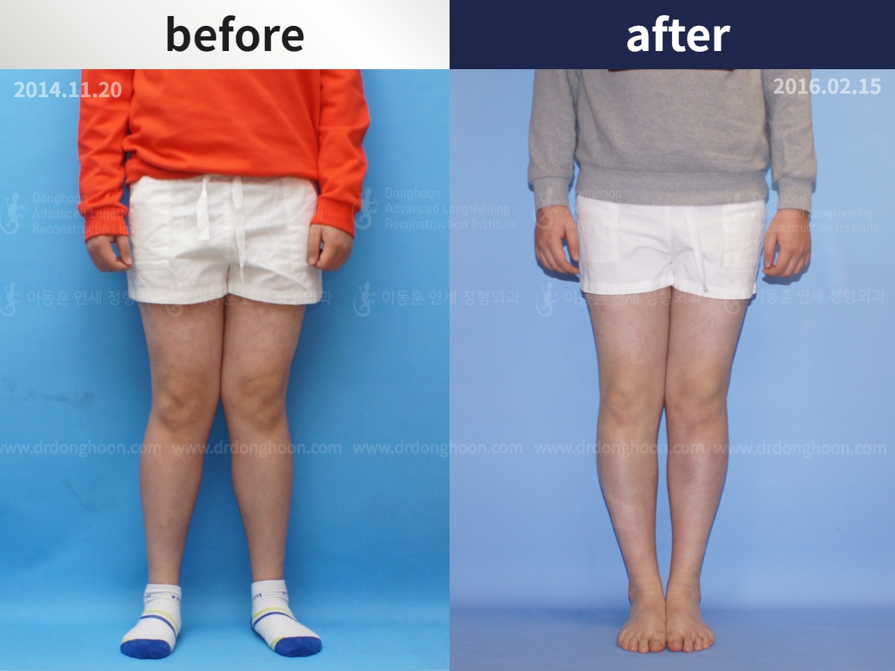 Before and after adult knock knees, case 4586317, image 1, Dr. Donghoon institute (DALRI)