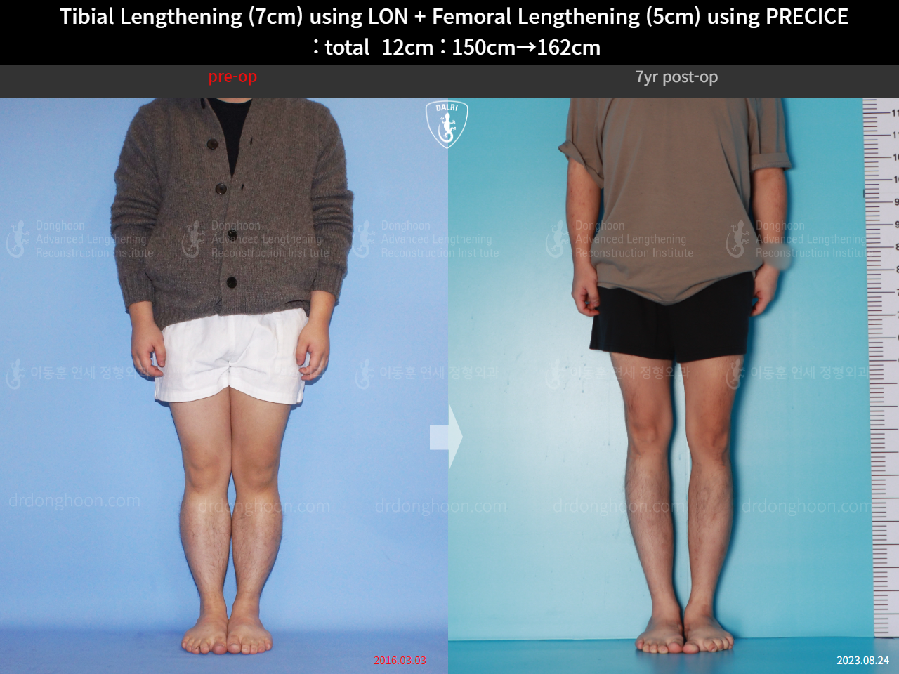 Before and after cll precice, case 16146445, image 5, Dr. Donghoon institute (DALRI)