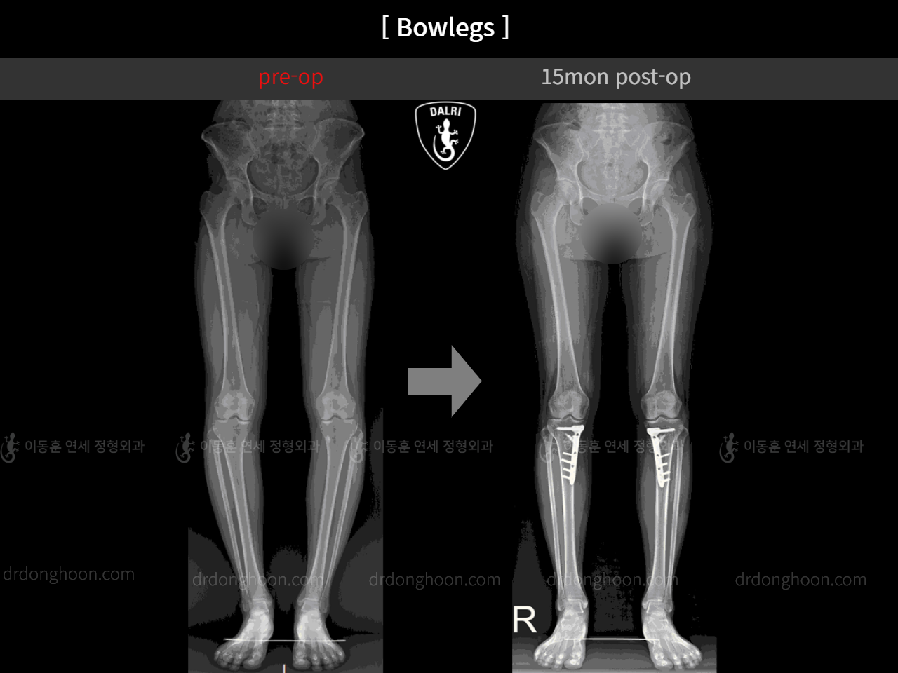 Before and after adult bowlegs, case 4311006, image 4, Dr. Donghoon institute (DALRI)