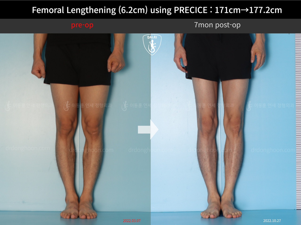 Before and after cll precice, case 13325833, image 9, Dr. Donghoon institute (DALRI)