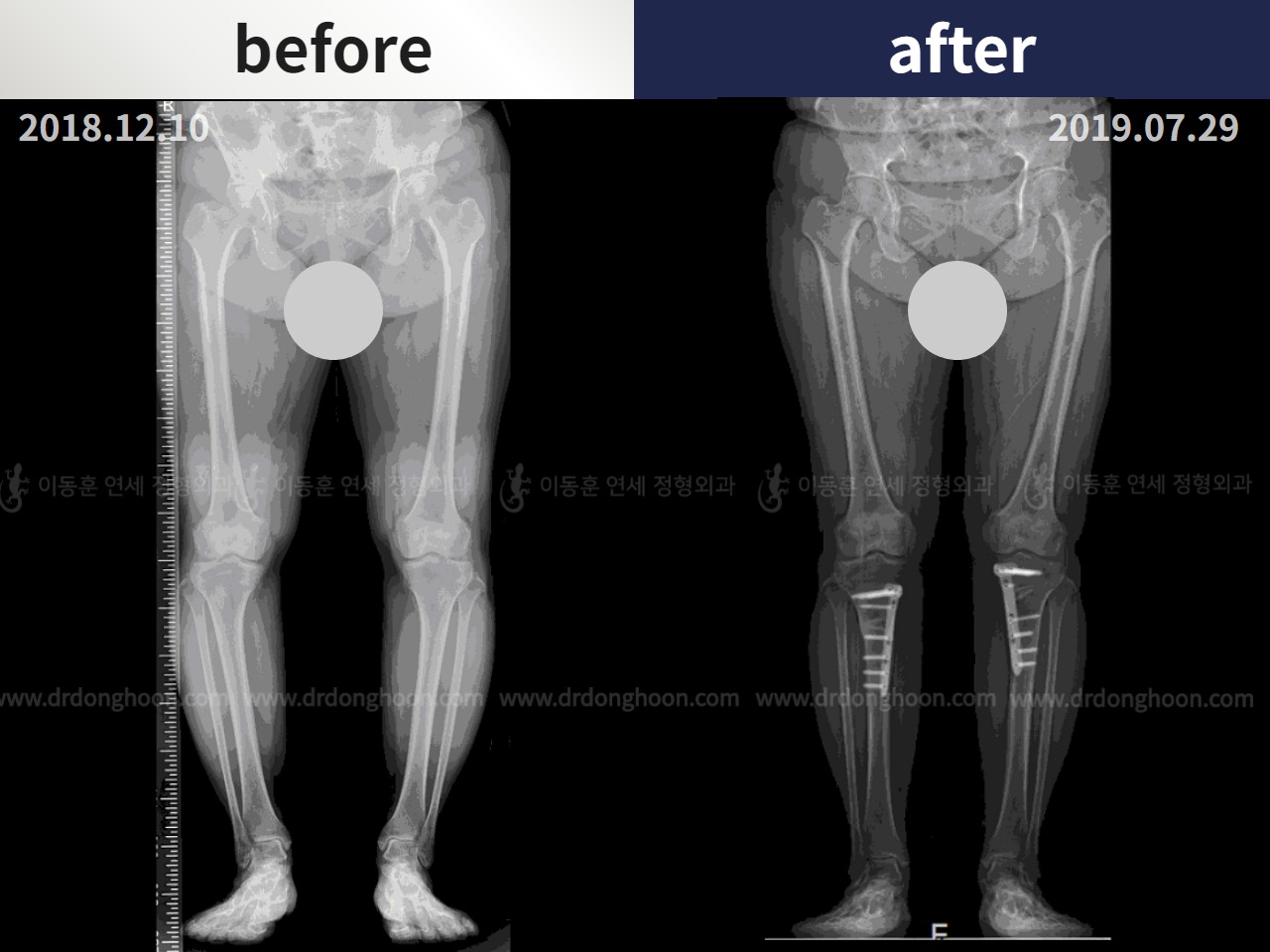 Before and after osteotomy for knee osteoarthritis, case 4306414, image 3, Dr. Donghoon institute (DALRI)