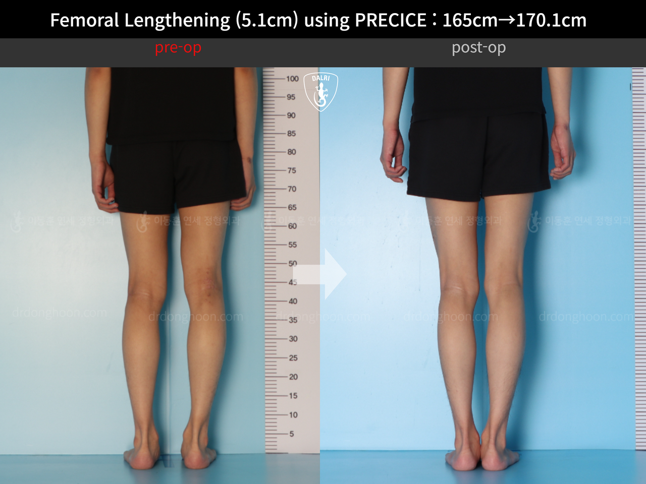 Before and after cll precice, case 13184743, image 6, Dr. Donghoon institute (DALRI)