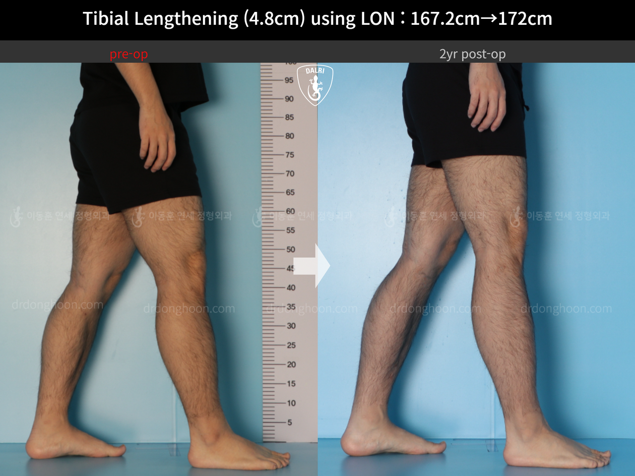 Before and after cll lon, case 14418932, image 7, Dr. Donghoon institute (DALRI)