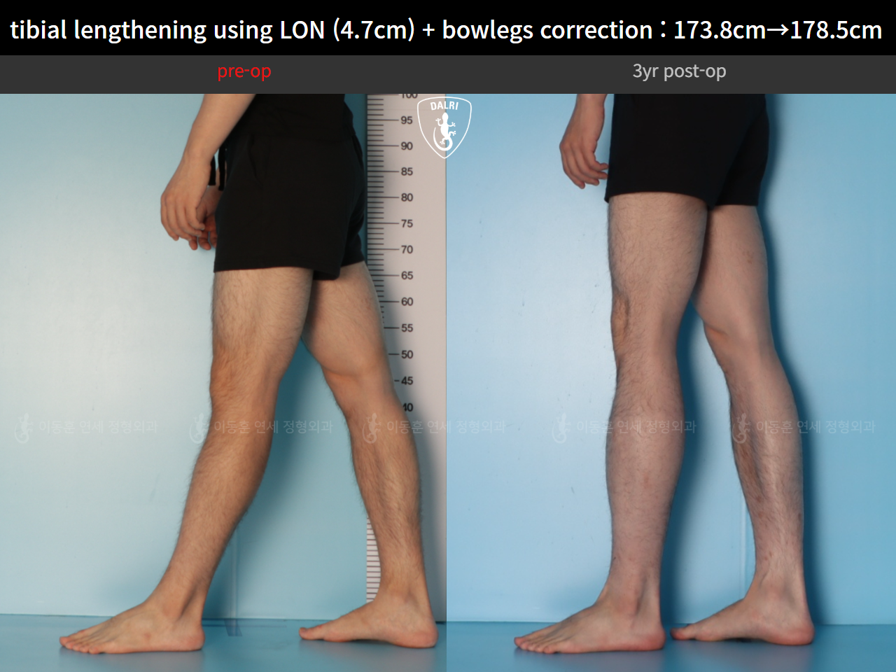 Before and after cll lon, case 128583026, image 10, Dr. Donghoon institute (DALRI)