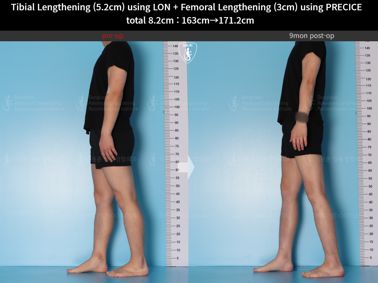 Before and after cll lon, case 15203339, image 9, Dr. Donghoon institute (DALRI)
