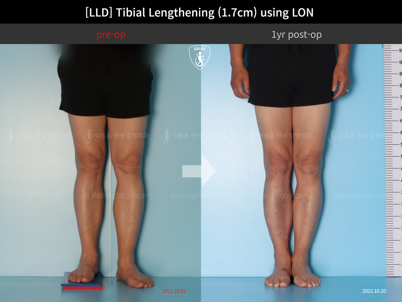 Before and after adult lld, case 13261805, image 4, Dr. Donghoon institute (DALRI)