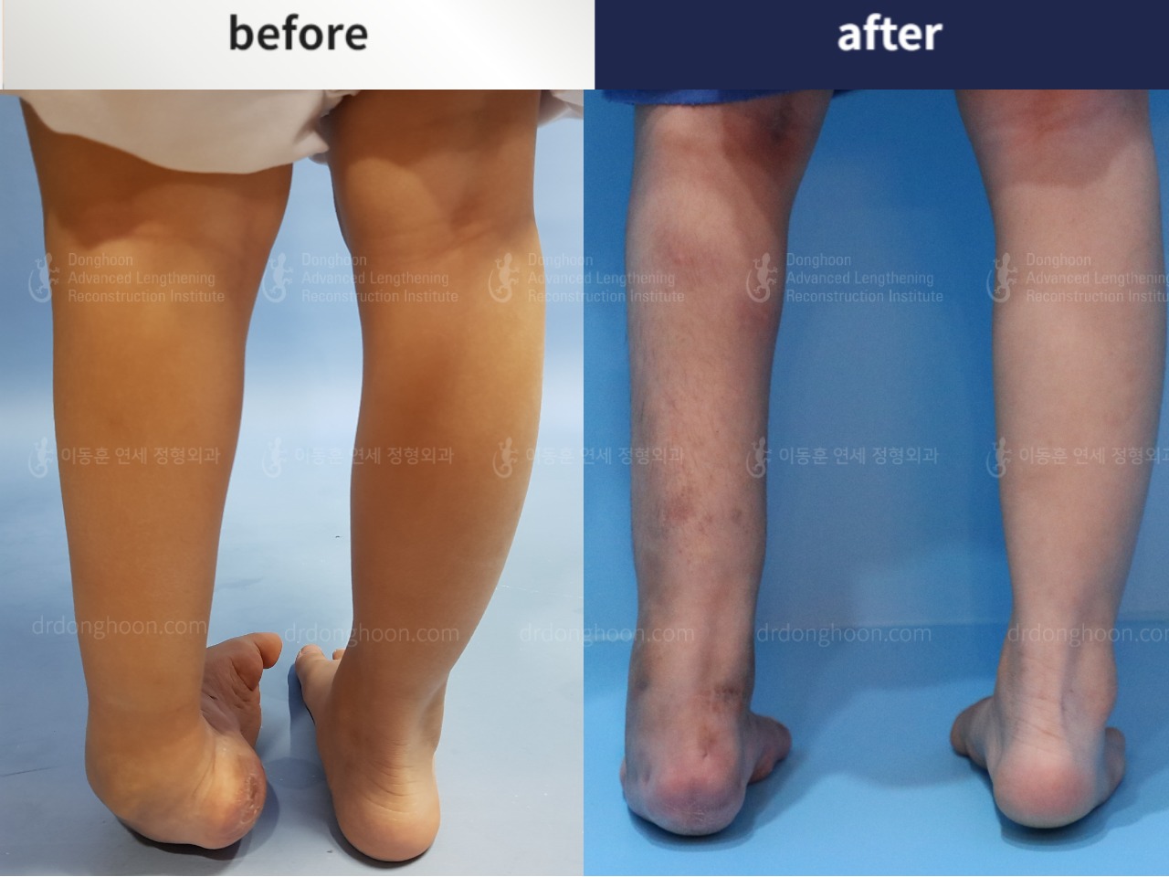 Before and after paediatric congenital condition, case 4304763, image 3, Dr. Donghoon institute (DALRI)