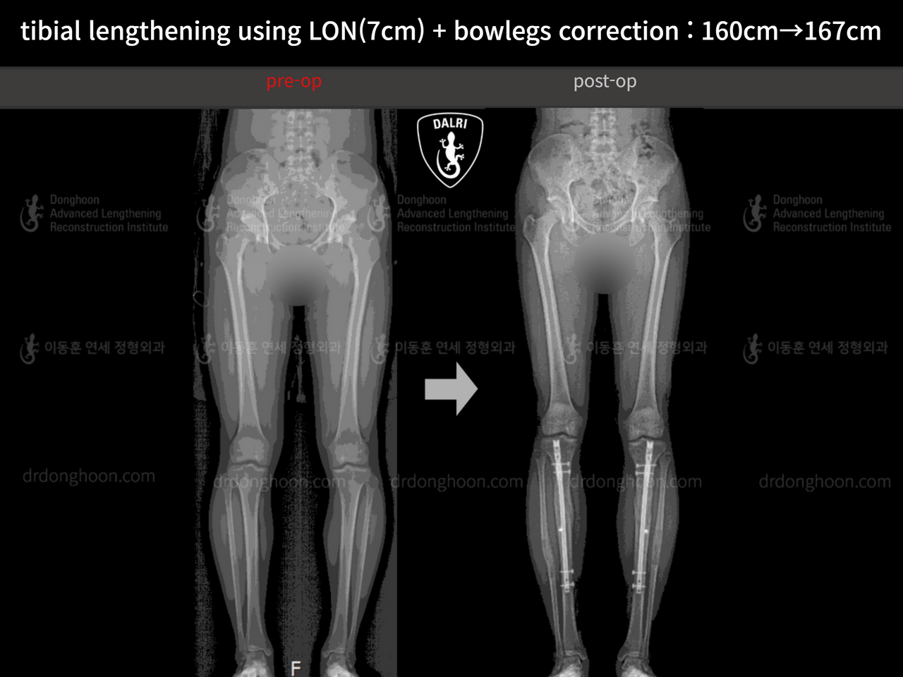 Before and after cll + deformity correction, case 13241722, image 9, Dr. Donghoon institute (DALRI)
