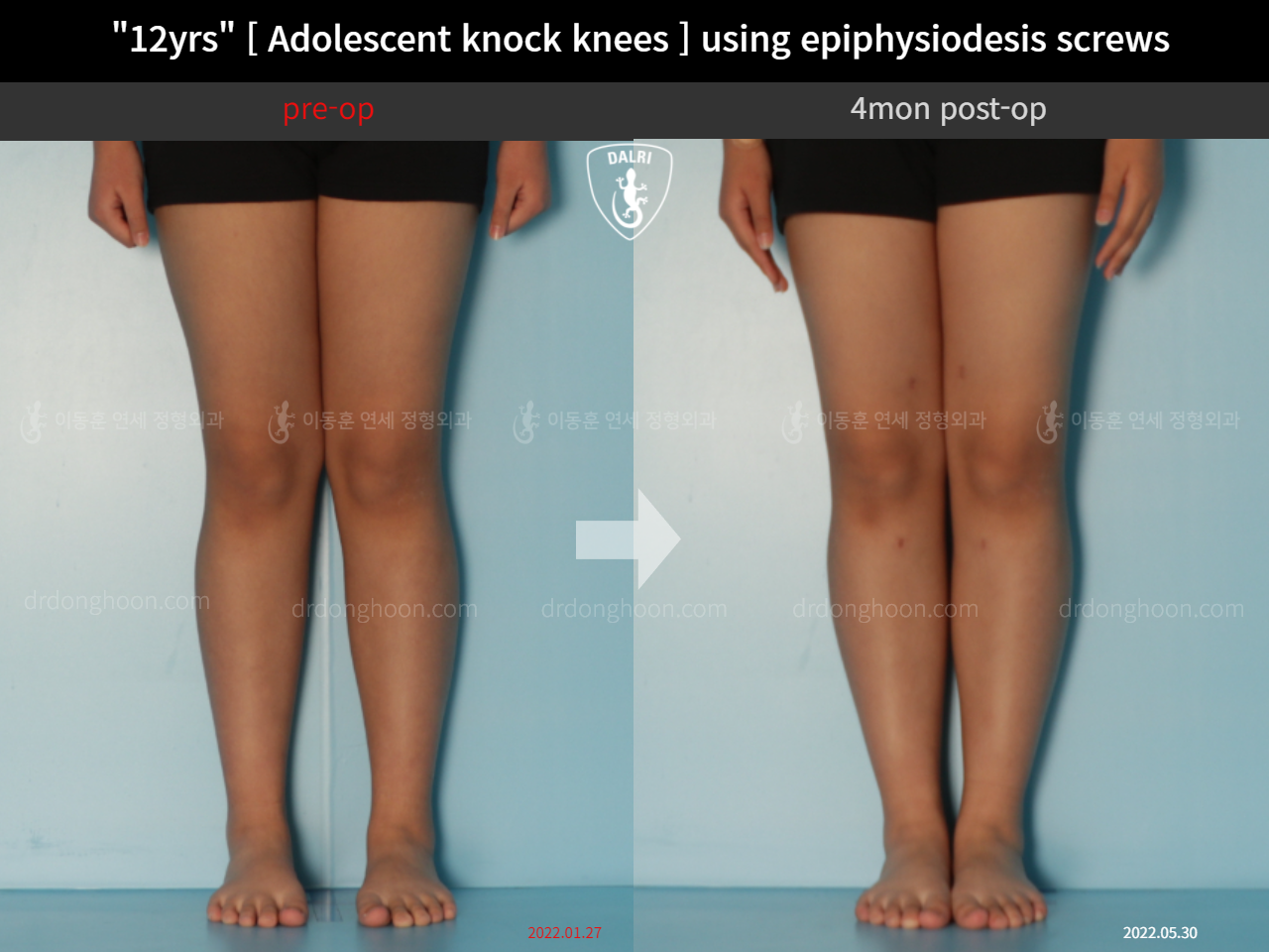Before and after paediatric & adolescent knock knees, case 11772917, image 3, Dr. Donghoon institute (DALRI)