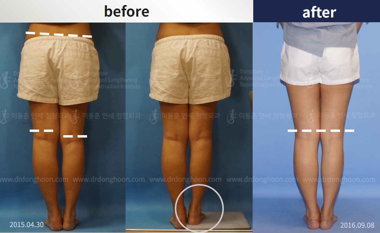 Before and after adult lld, case 4320289, image 2, Dr. Donghoon institute (DALRI)