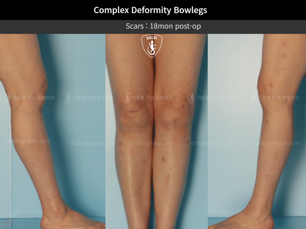 Before and after osteotomy for knee osteoarthritis, case 11337460, image 7, Dr. Donghoon institute (DALRI)