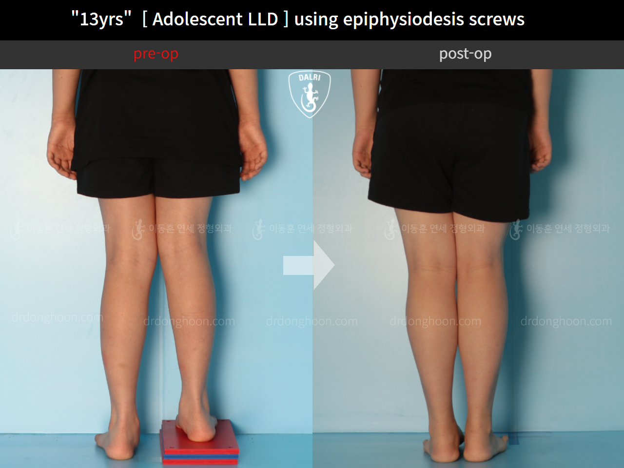 Before and after paediatric & adolescent lld, case 11773378, image 5, Dr. Donghoon institute (DALRI)