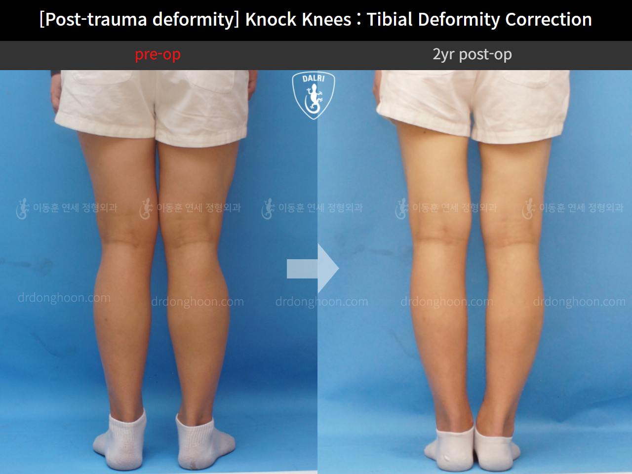 Before and after adult knock knees, case 4310821, image 4, Dr. Donghoon institute (DALRI)