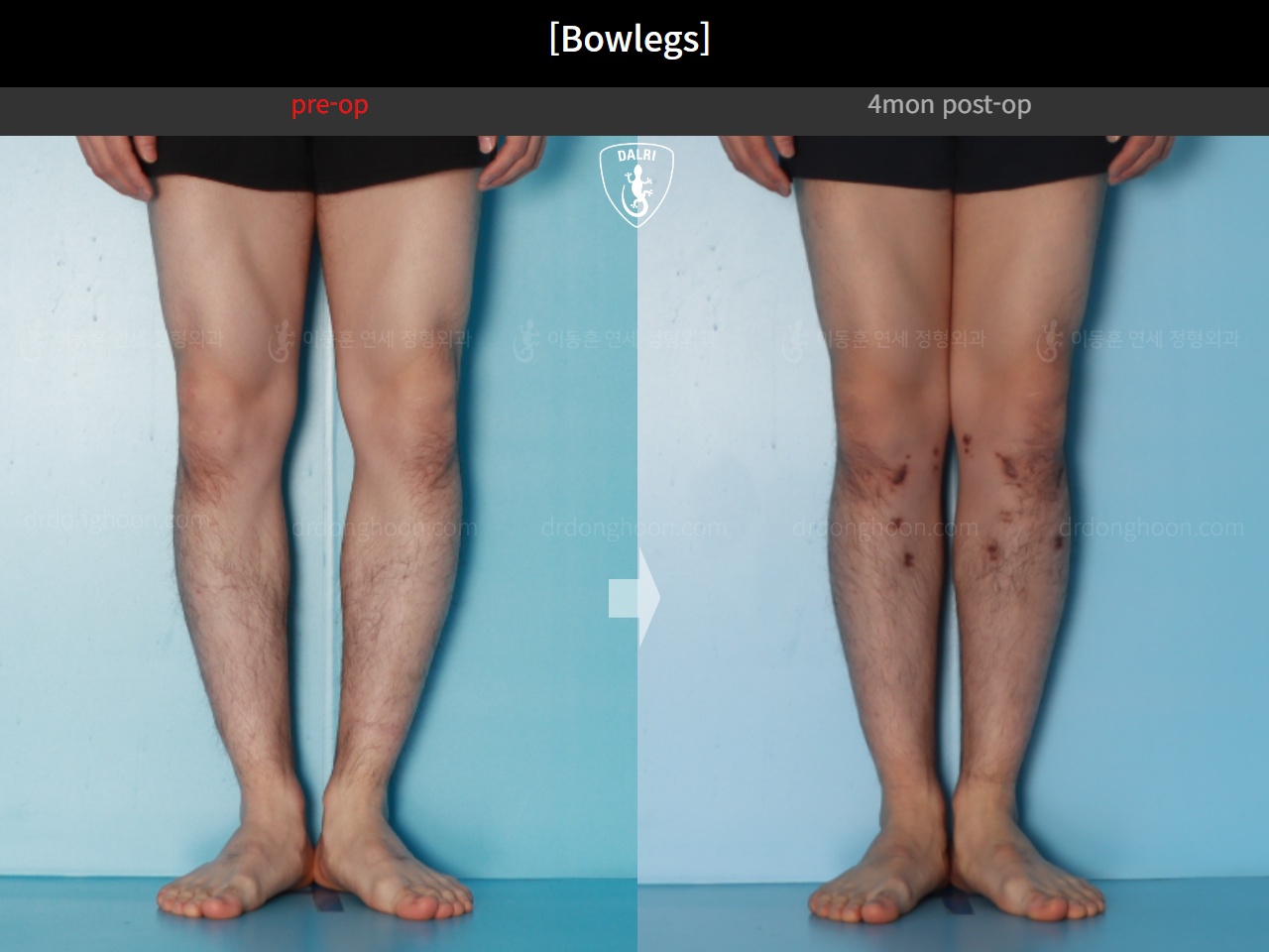 Before and after adult bowlegs, case 21098909, image 7, Dr. Donghoon institute (DALRI)