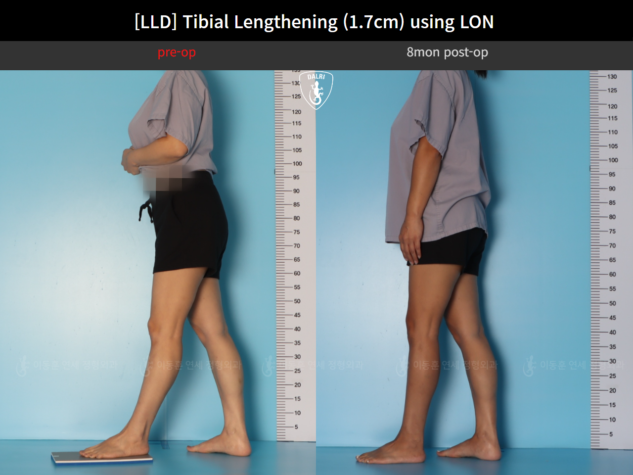 Before and after adult lld, case 126715948, image 4, Dr. Donghoon institute (DALRI)