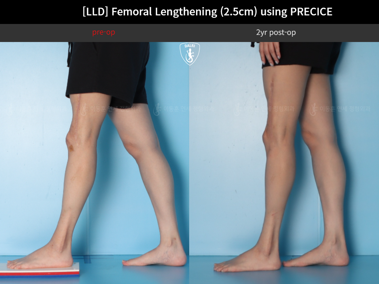 Before and after adult lld, case 89087135, image 7, Dr. Donghoon institute (DALRI)