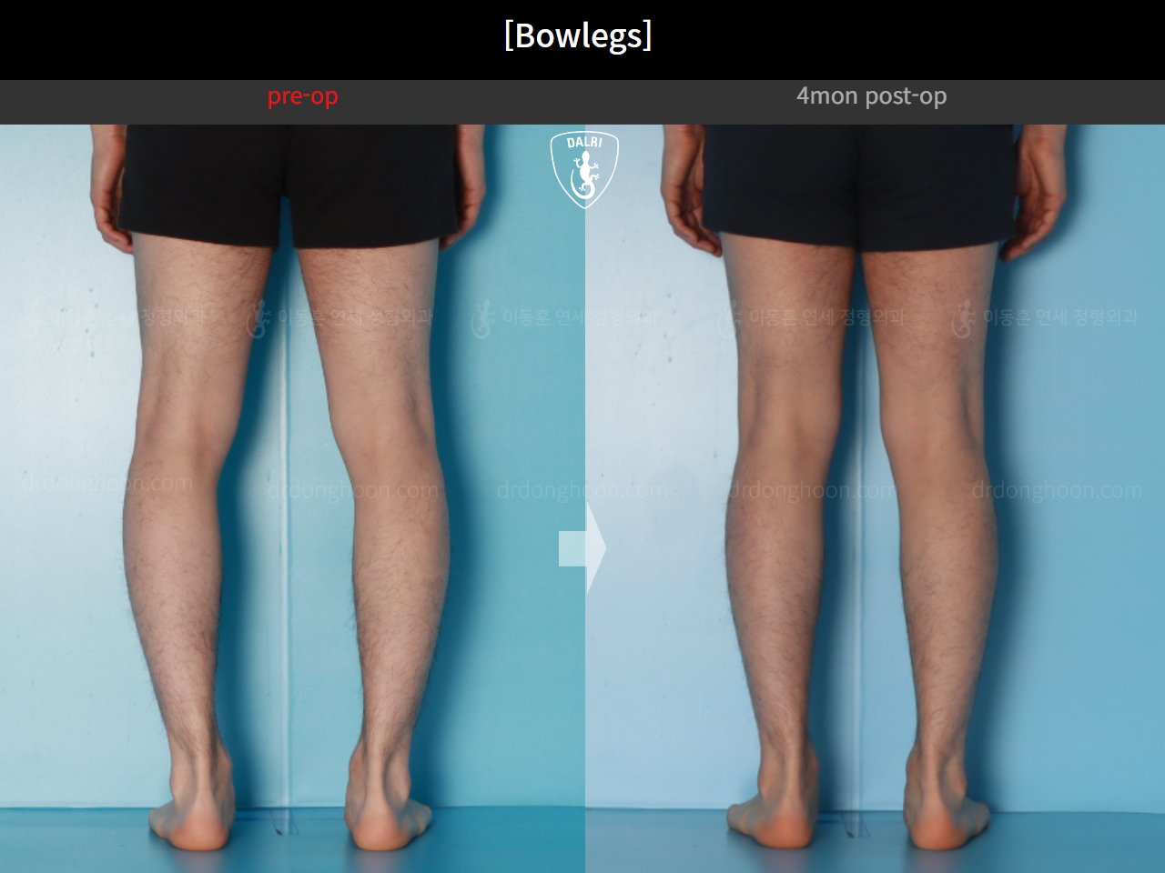 Before and after adult bowlegs, case 21098909, image 10, Dr. Donghoon institute (DALRI)