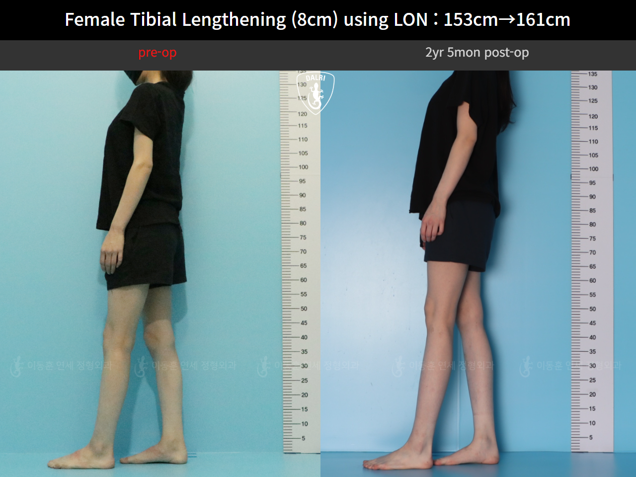 Before and after cll lon, case 128135191, image 6, Dr. Donghoon institute (DALRI)