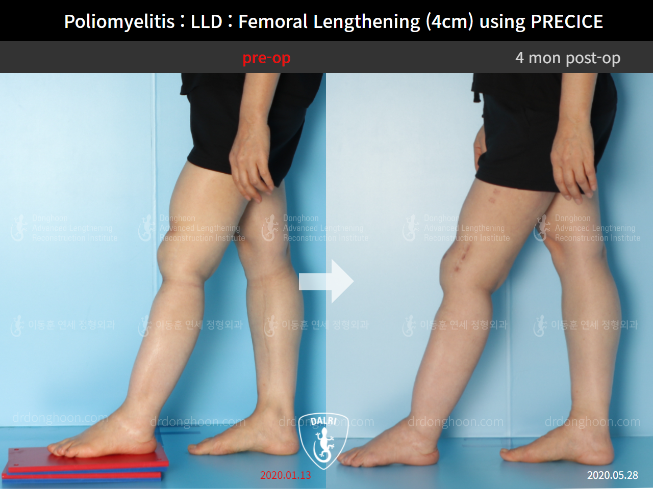Before and after congenital condition, case 9191055, image 6, Dr. Donghoon institute (DALRI)