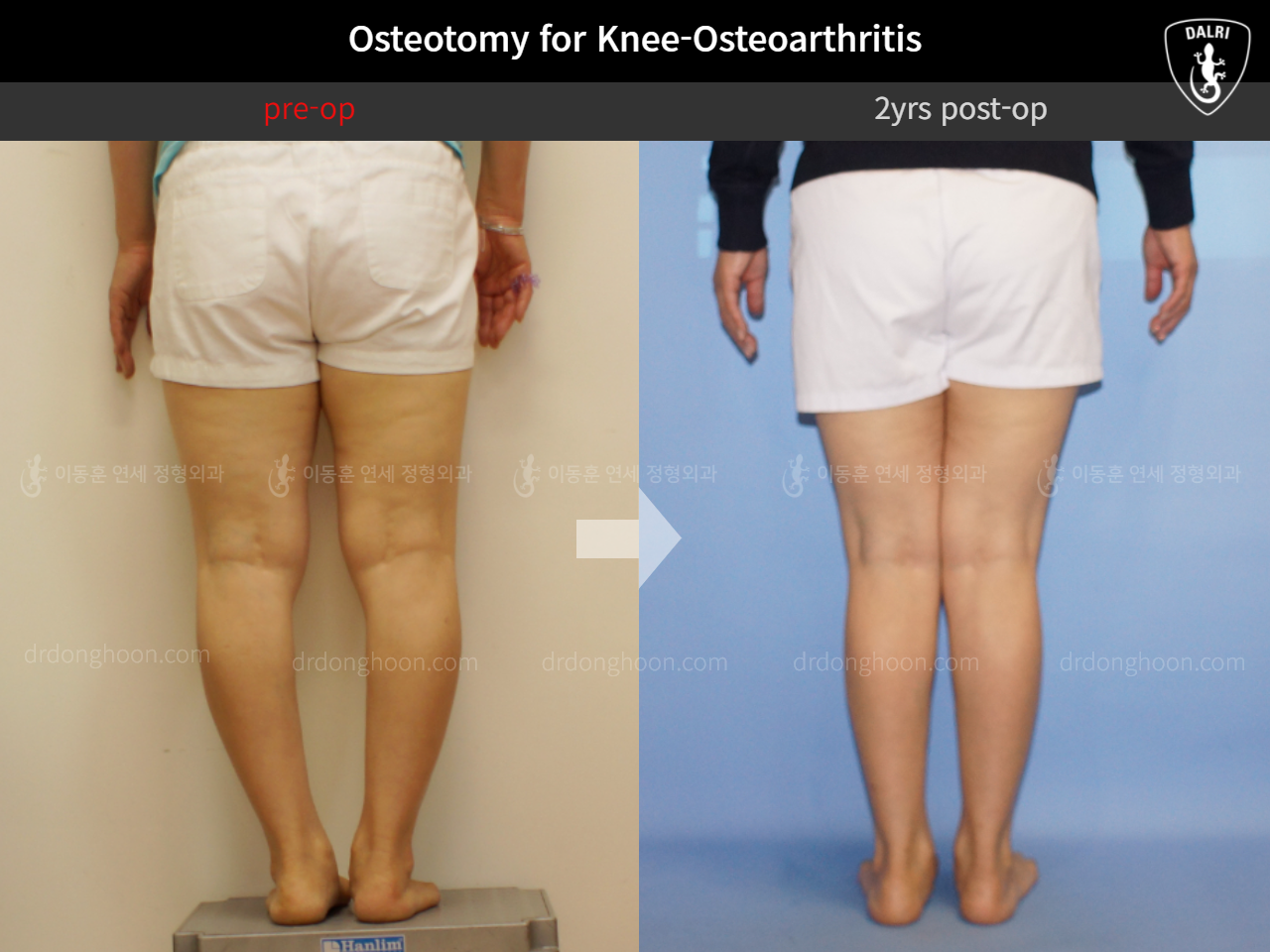 Before and after osteotomy for knee osteoarthritis, case 11785573, image 6, Dr. Donghoon institute (DALRI)