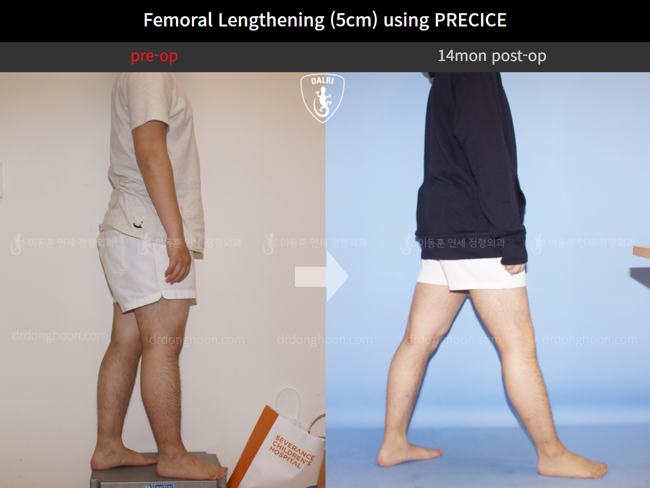 Before and after cll precice, case 4323249, image 4, Dr. Donghoon institute (DALRI)