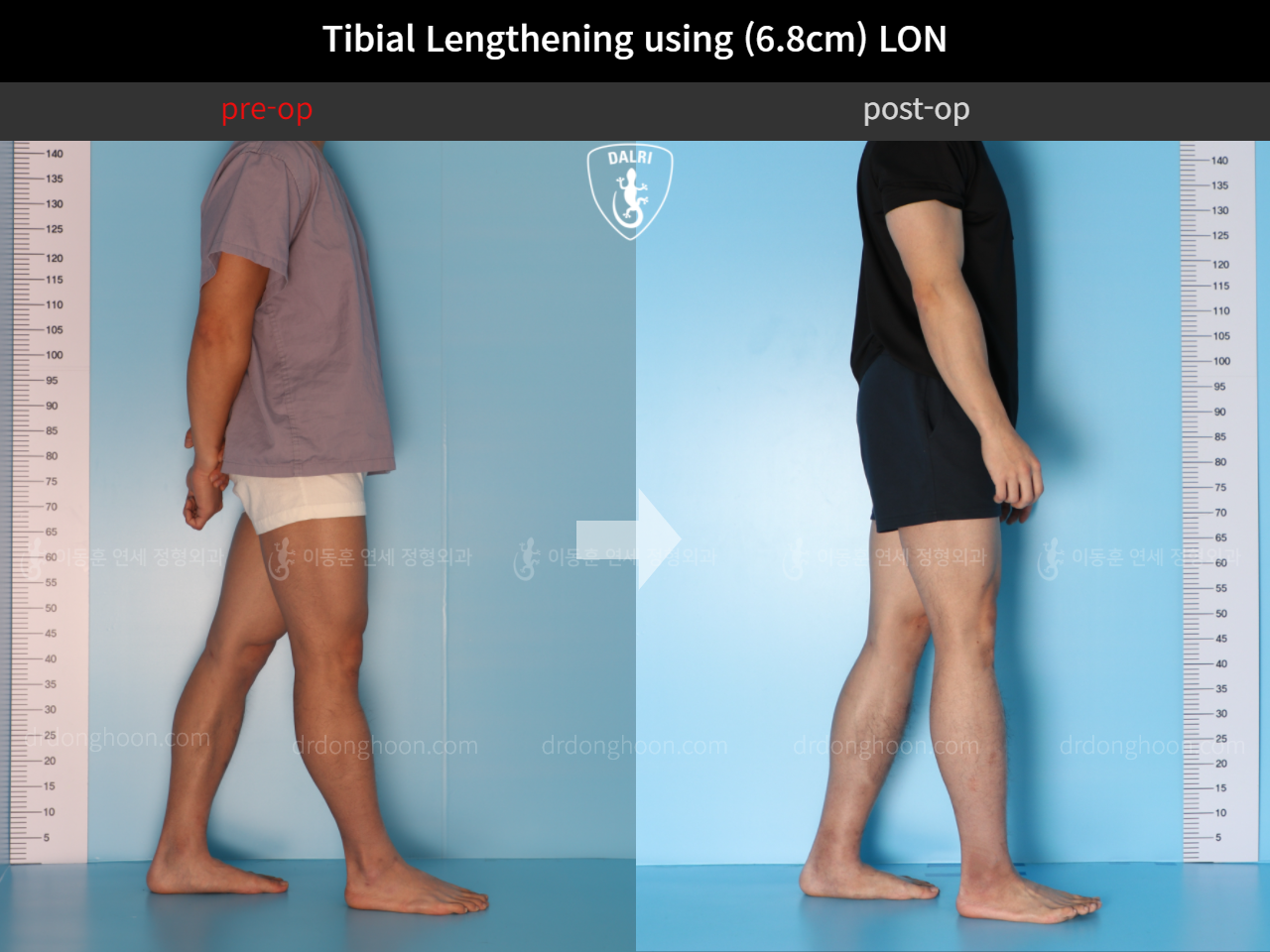 Before and after cll lon, case 4577738, image 4, Dr. Donghoon institute (DALRI)