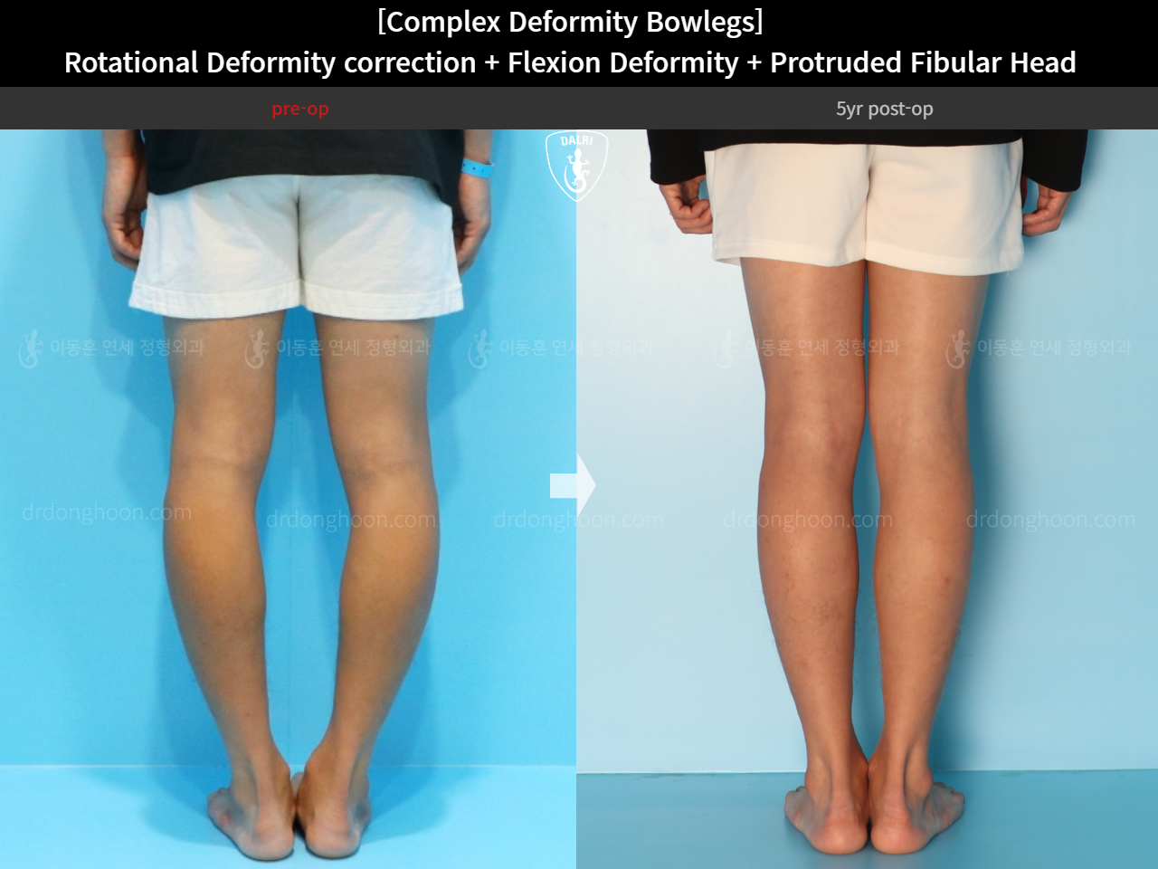 Before and after complex deformity, case 15944755, image 8, Dr. Donghoon institute (DALRI)
