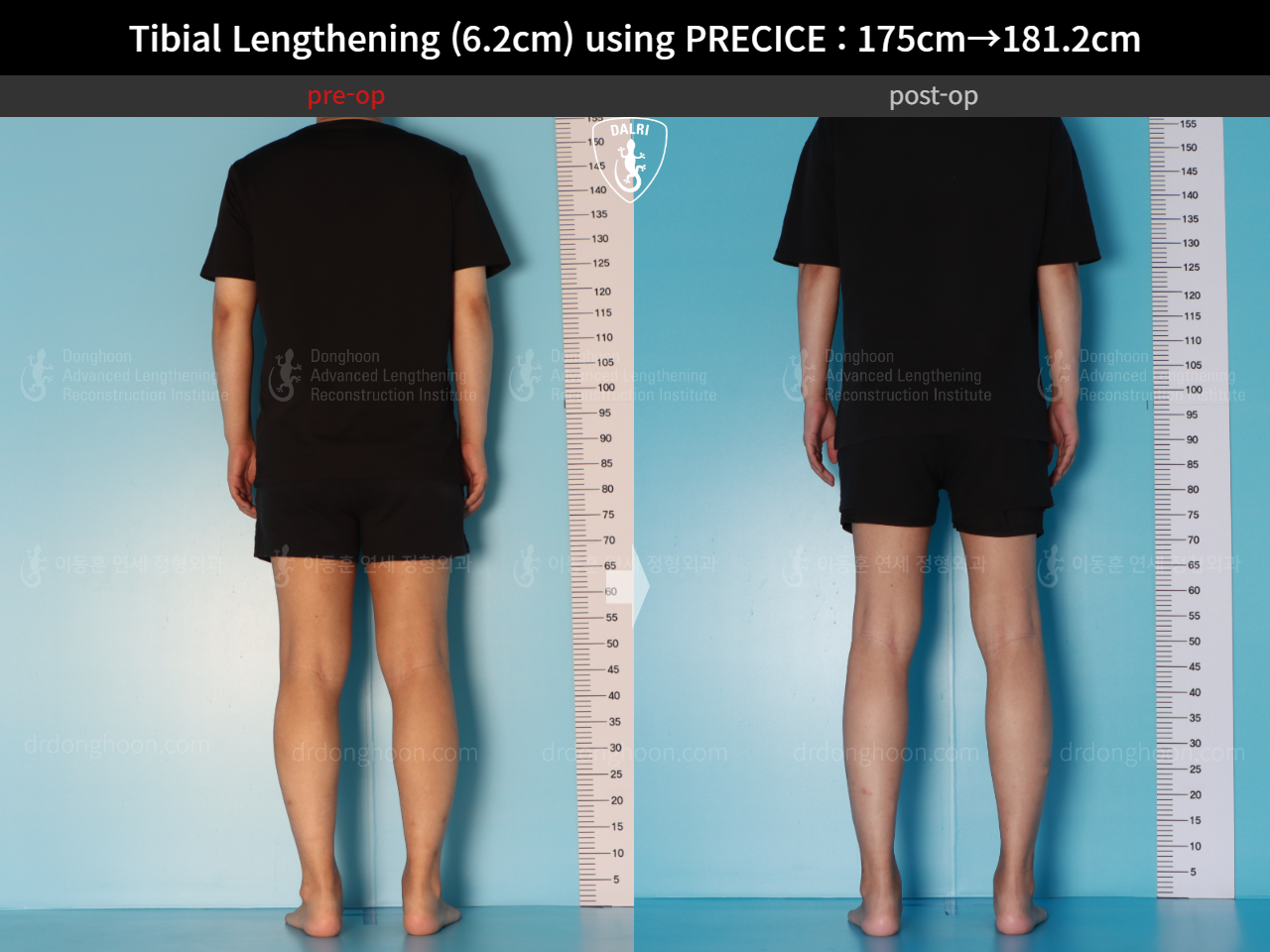 Before and after cll precice, case 16277428, image 4, Dr. Donghoon institute (DALRI)