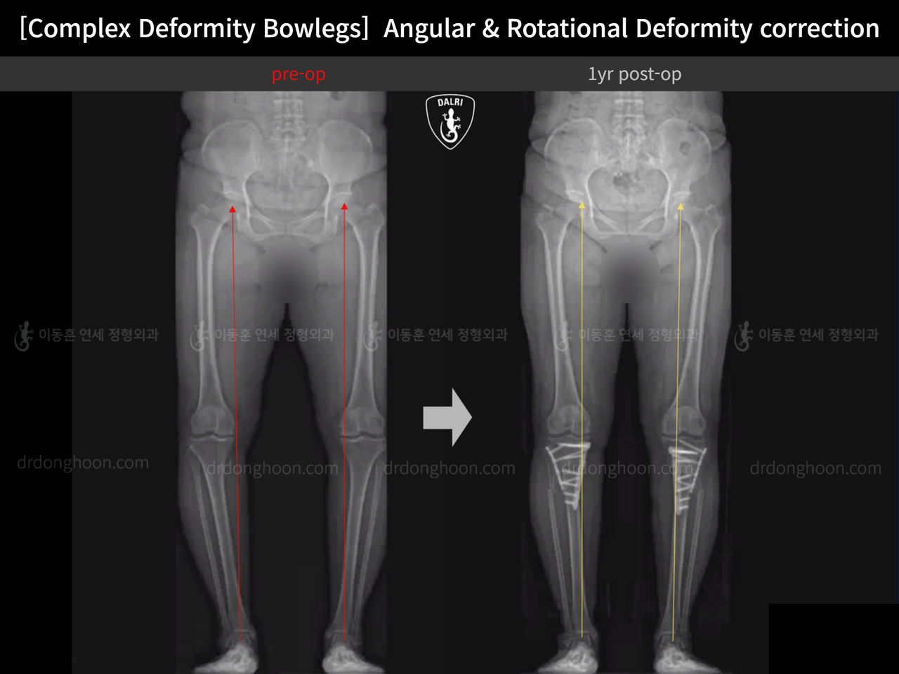 Before and after adult bowlegs, case 14378683, image 8, Dr. Donghoon institute (DALRI)