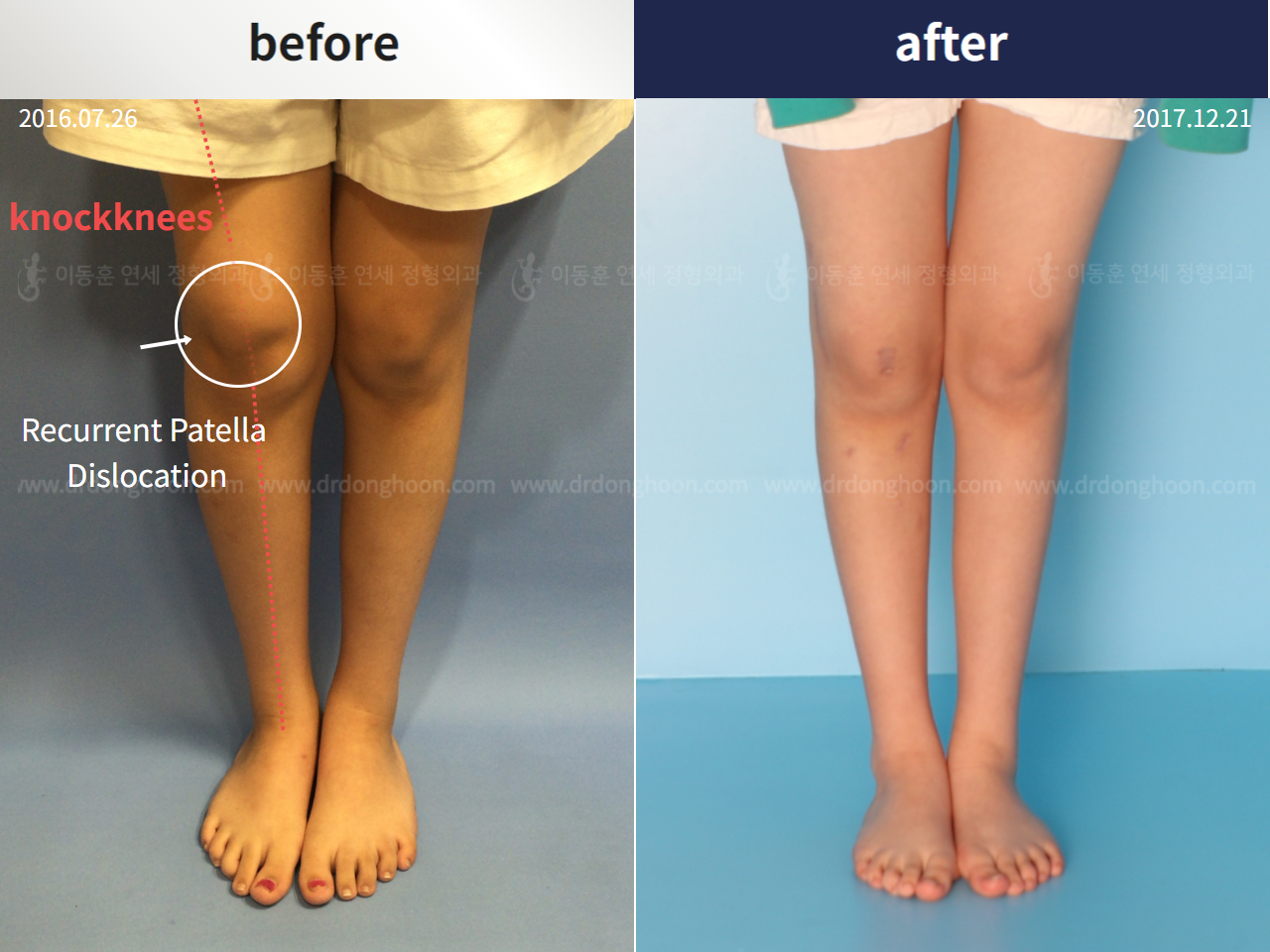 Before and after complex deformity, case 4251599, image 1, Dr. Donghoon institute (DALRI)