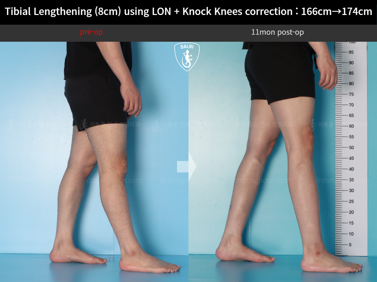Before and after cll + deformity correction, case 20789954, image 9, Dr. Donghoon institute (DALRI)