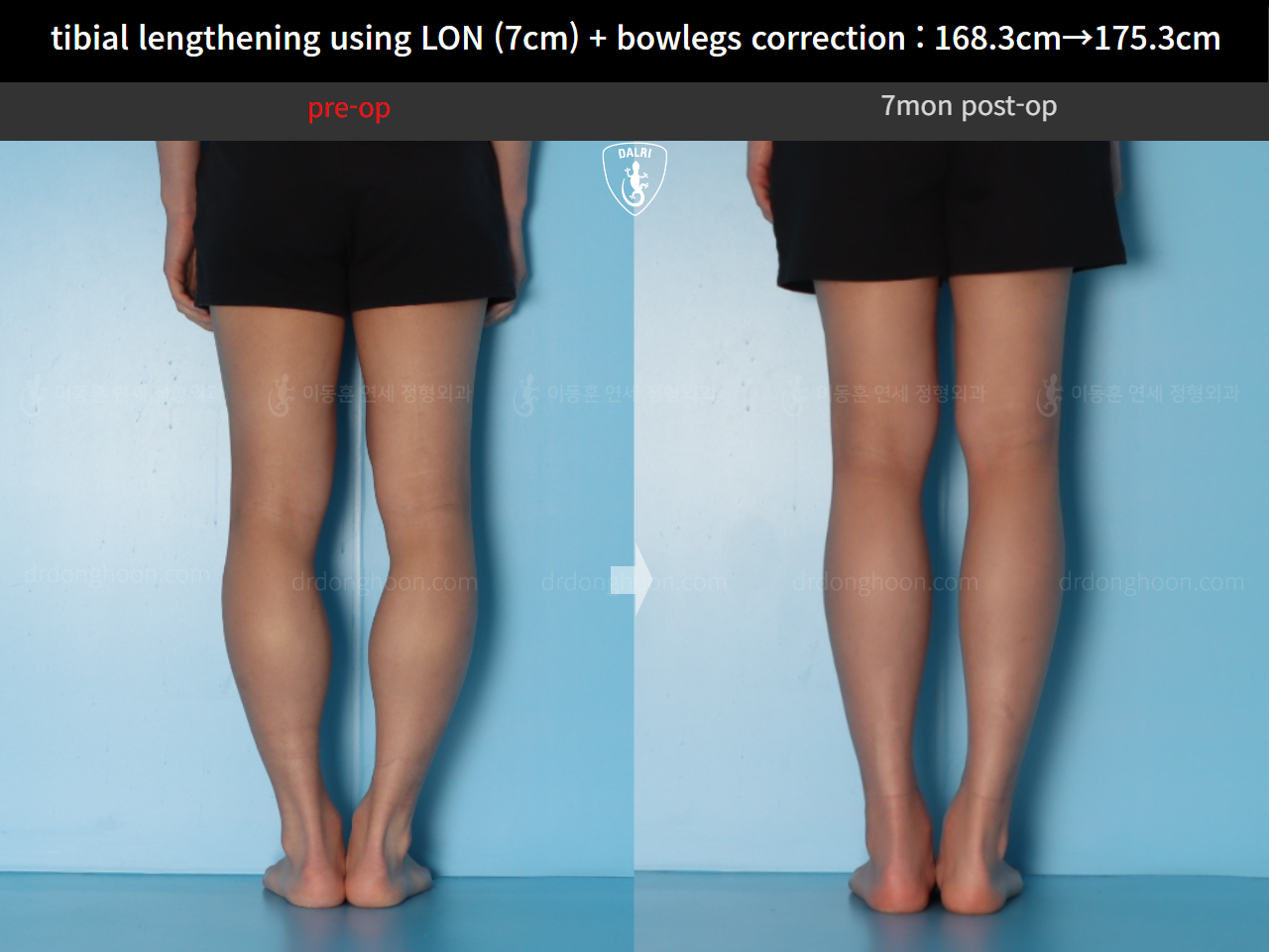 Before and after cll + deformity correction, case 21918246, image 8, Dr. Donghoon institute (DALRI)